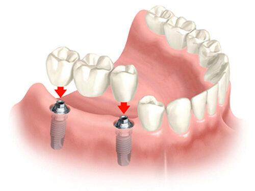 Công nghệ implant là gì? tìm hiểu về phương pháp cấy ghép răng hiện đại